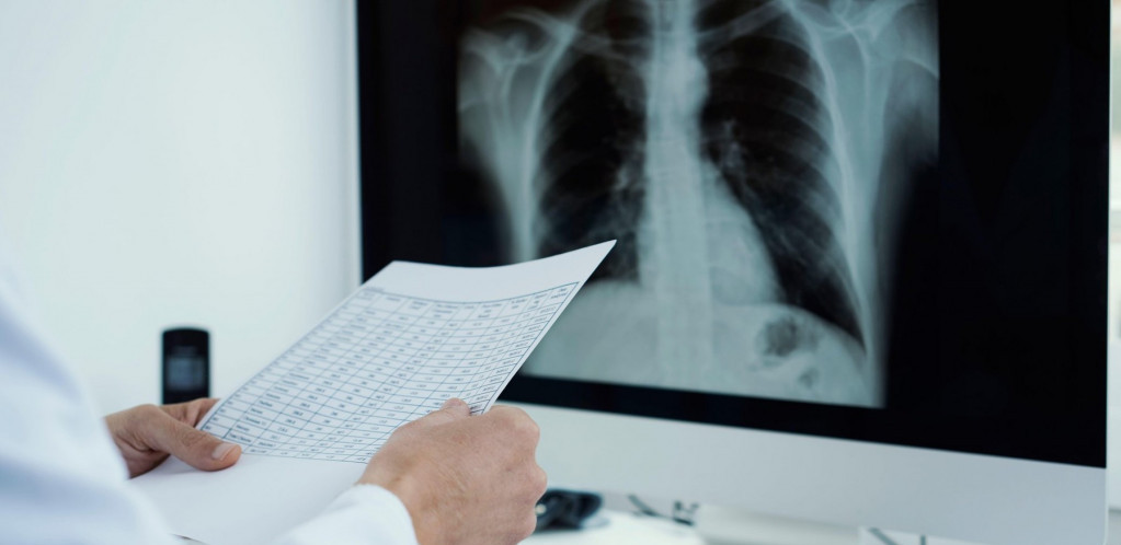 Da li upala pluća kod obolelih od kovida 19 može proći bez ijednog simptoma?