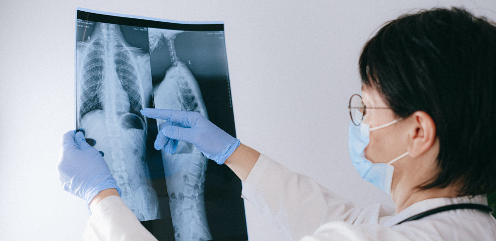 Rezultati pilot studije: Kod pacijenata koji dugo imaju kovid moguća skrivena upala pluća