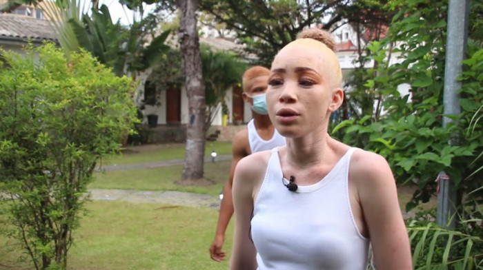 Albino ljudi u Africi ne žele više da budu tabu tema i sada su hrabro iskoračili u žižu javnosti