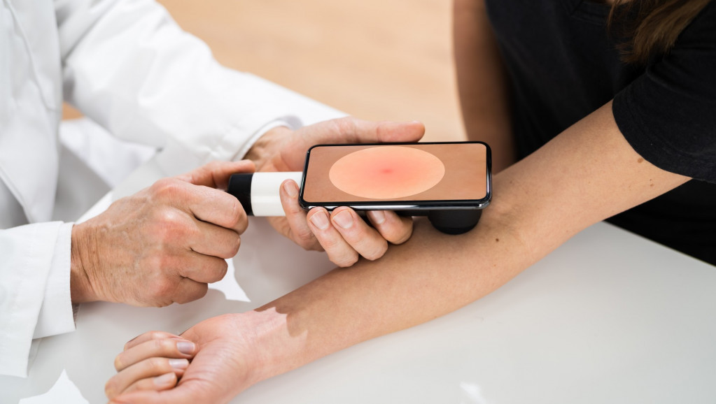 Mesec borbe protiv melanoma: Godišnje u Srbiji od raka kože oboli 7.000 ljudi