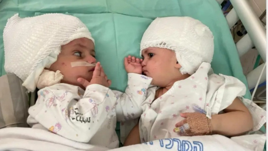 Prvi put se pogledale u oči: U Izraelu uspešno razdvojene sijamske bliznakinje