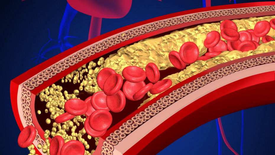 U Britaniji odobren lek protiv holesterola koji bi mogao da spasi 30.000 života u narednoj deceniji