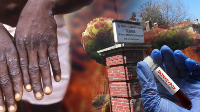 Raste broj žrtava od majmunskih boginja u Južnoj Africi: Zabeležen treći smrtni slučaj