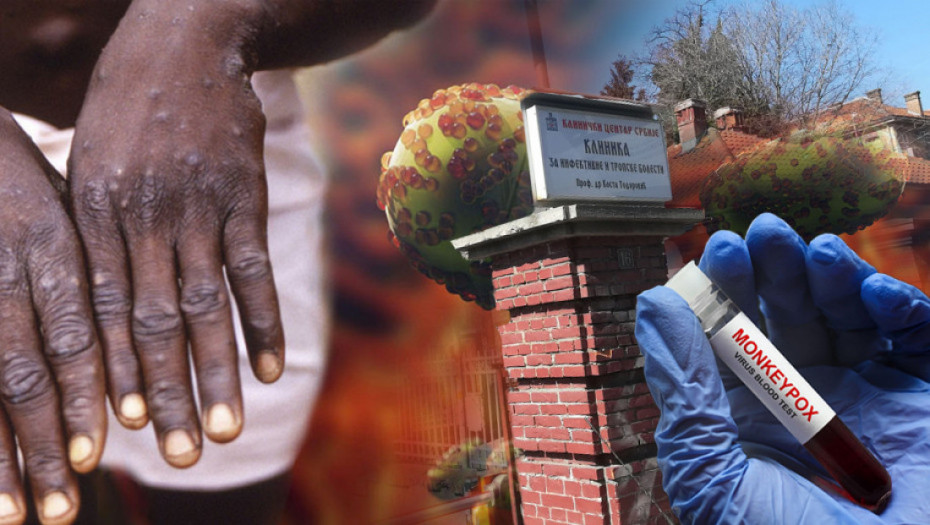 Raste broj žrtava od majmunskih boginja u Južnoj Africi: Zabeležen treći smrtni slučaj
