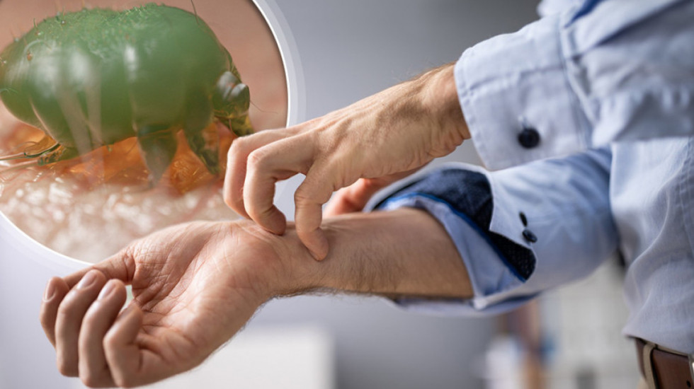 Šuga u vrtiću i školi u Umci: : Četvoro mališana i vaspitačica zaraženi - stručnjak upozorava na prenos i lečenje