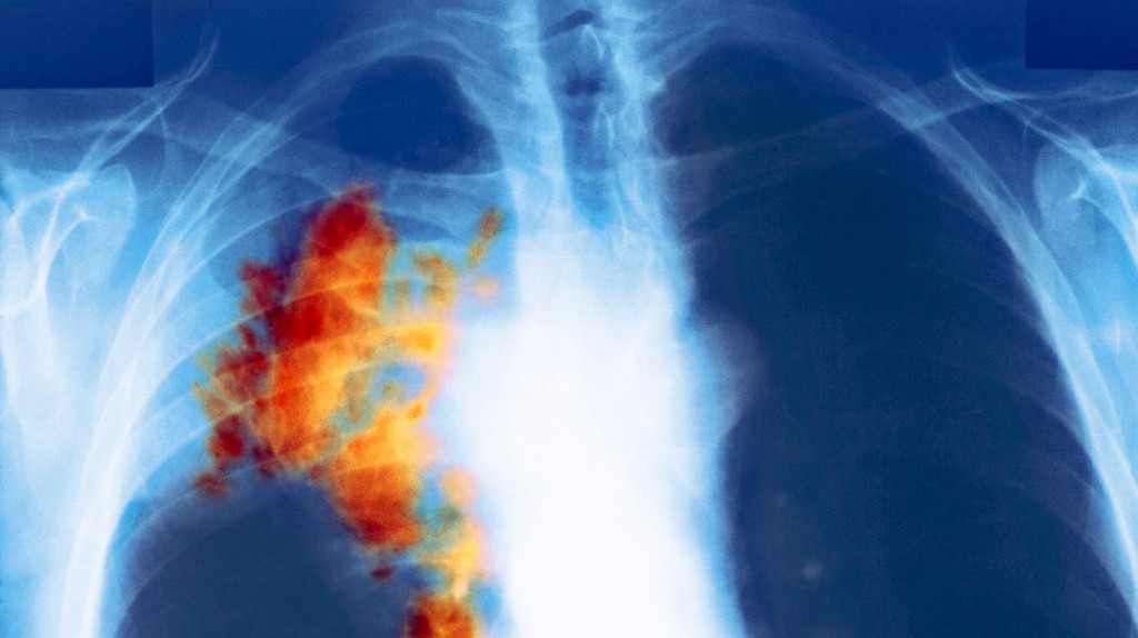 Dijagnostika raka pluća je brža,ali pacijenti čekaju na primenu terapije i do 40 dana