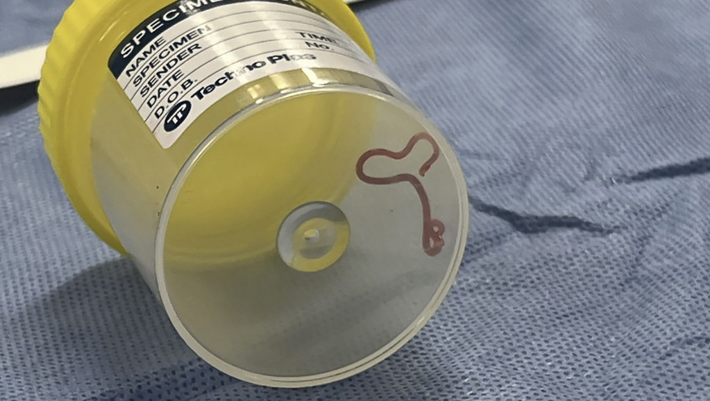 Lekari u mozgu pacijentkinje pronašli živog crva od osam centimetara