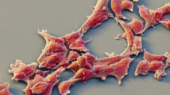 Velika nada za lečenje sarkoma: Naučnici pronašli način da ćelije agresivnog oblika raka pretvore u zdrave ćelije