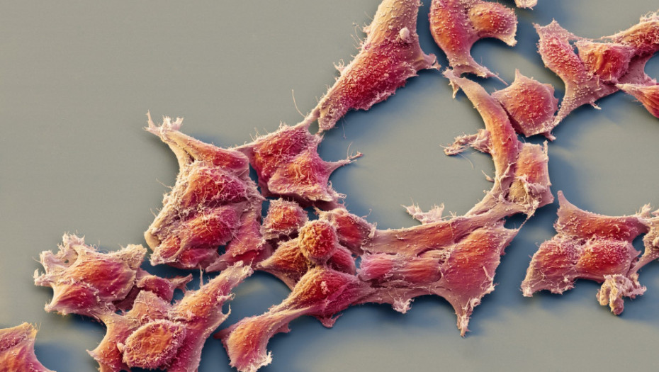 Velika nada za lečenje sarkoma: Naučnici pronašli način da ćelije agresivnog oblika raka pretvore u zdrave ćelije