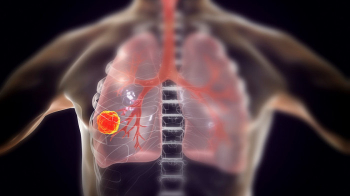Napredak koji uliva nadu: Nova vakcina protiv raka pluća mogla bi da prepolovi broj smrtnih slučajeva