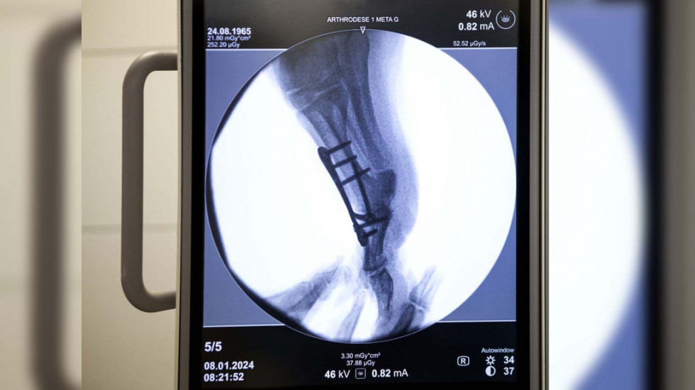 Skoro 20.000 pacijenata na čekanju za ugradnju kuka i kolena: Da li će nova pravila ubrzati operacije?