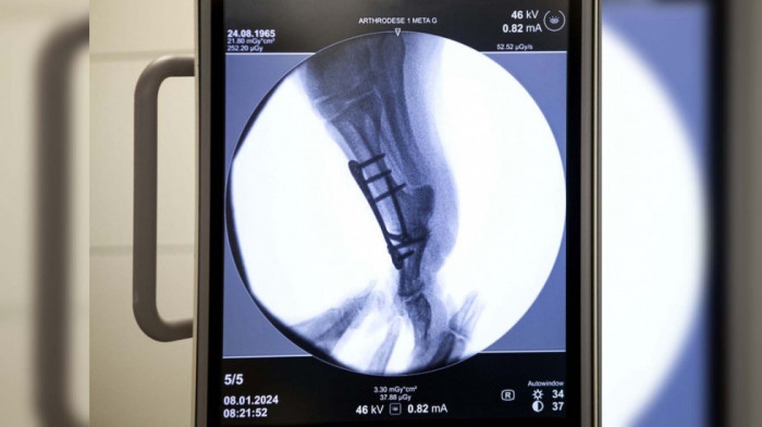 Skoro 20.000 pacijenata na čekanju za ugradnju kuka i kolena: Da li će nova pravila ubrzati operacije?