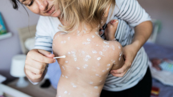 Može li Novi Pazar da bude novo žarište epidemije malih boginja: Lekari zabrinuti, mali obuhvat vakcinisane dece