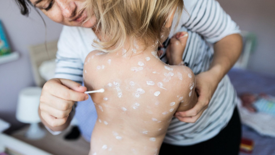 U Banjaluci i Bijeljini prijavljena epidemija malih boginja: Zaražene 52 osobe, među obolelima najviše dece