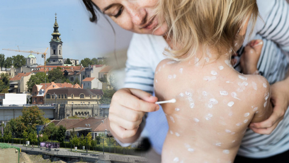 Institut "Batut": Ne jenjava zaraza morbilama, u Srbiji registrovan 181 slučaj malih boginja