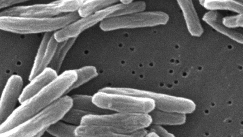 SZO odobrila revolucionarni dijagnostički test za tuberkulozu: Prepoznaje bolest i osetljivost na antibiotike