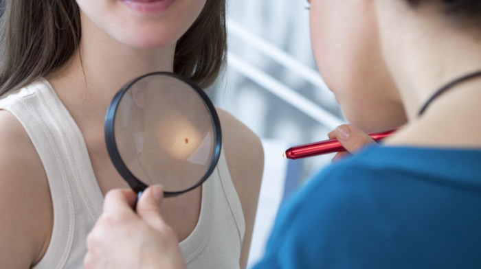 Mesec borbe protiv melanoma: Ko spada u rizične grupe i šta je osnovna prevencija