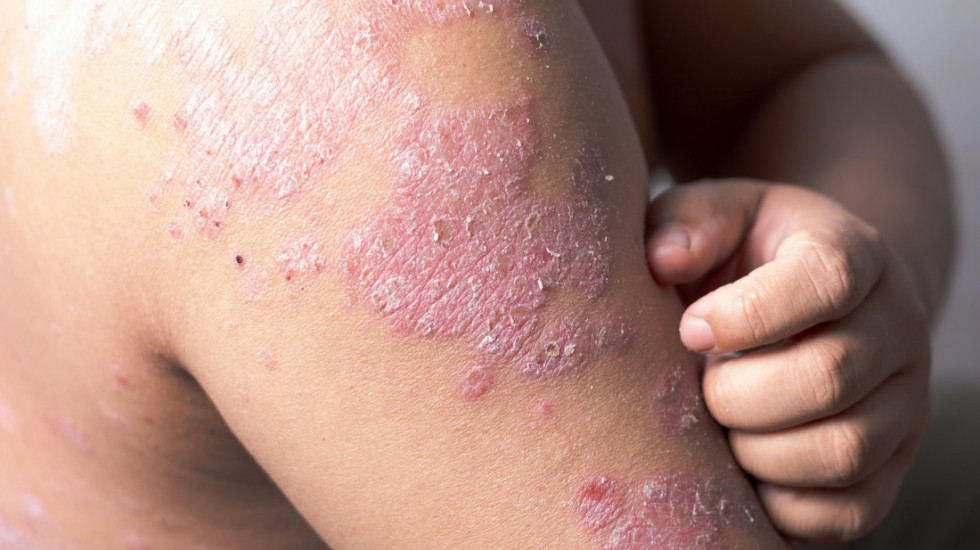 U Srbiji 140.000 ljudi boluje od psorijaze: Najveći problem - pacijenti se ne javljaju lekarima