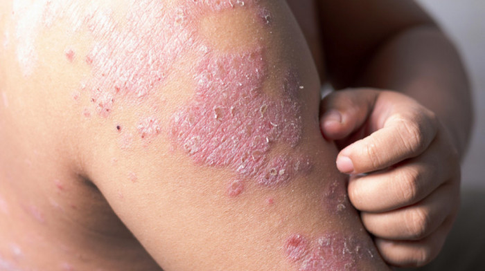 U Srbiji 140.000 ljudi boluje od psorijaze: Najveći problem - pacijenti se ne javljaju lekarima