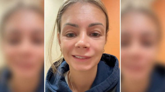 Završila u bolnici zbog bubuljice u "trouglu smrti": Devojci se paralizovao deo lica, mogla je da prođe mnogo gore