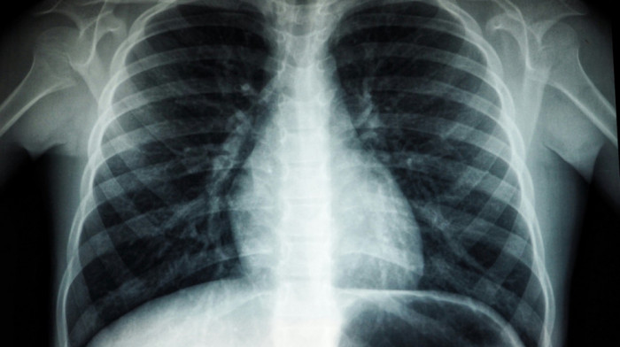 Medicinski fenomen: Čovek osam godina živeo s nožem u grudima, a da to nije znao