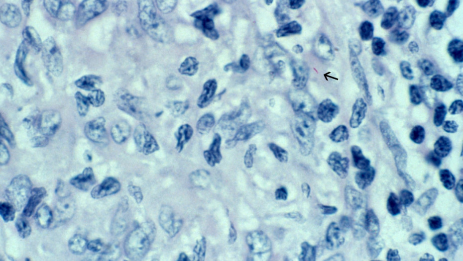 Lepra u čak dve zemlje u komšiluku: Sve što treba da znamo o istorijskoj bolesti - koji su prvi simptomi?