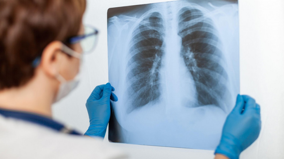 U Srbiji svake godine od raka pluća oboli oko 7.000 ljudi - uprkos organizovanom skriningu