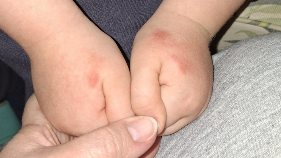 Crvenilo i ispucala koža: Više od 1.600 dece u vrtićima u Beogradu ima problem sa šakama