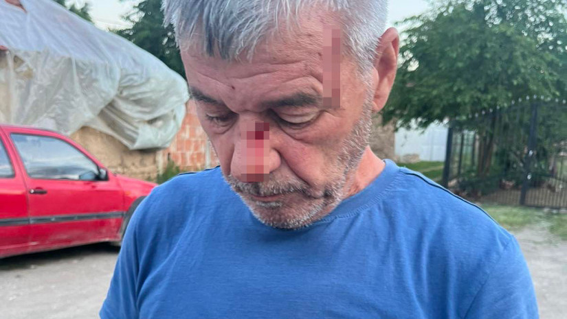 Kancelarija za KiM: Srbin na Kosovu pretučen dok je pokušao da odbrani sina od napadača